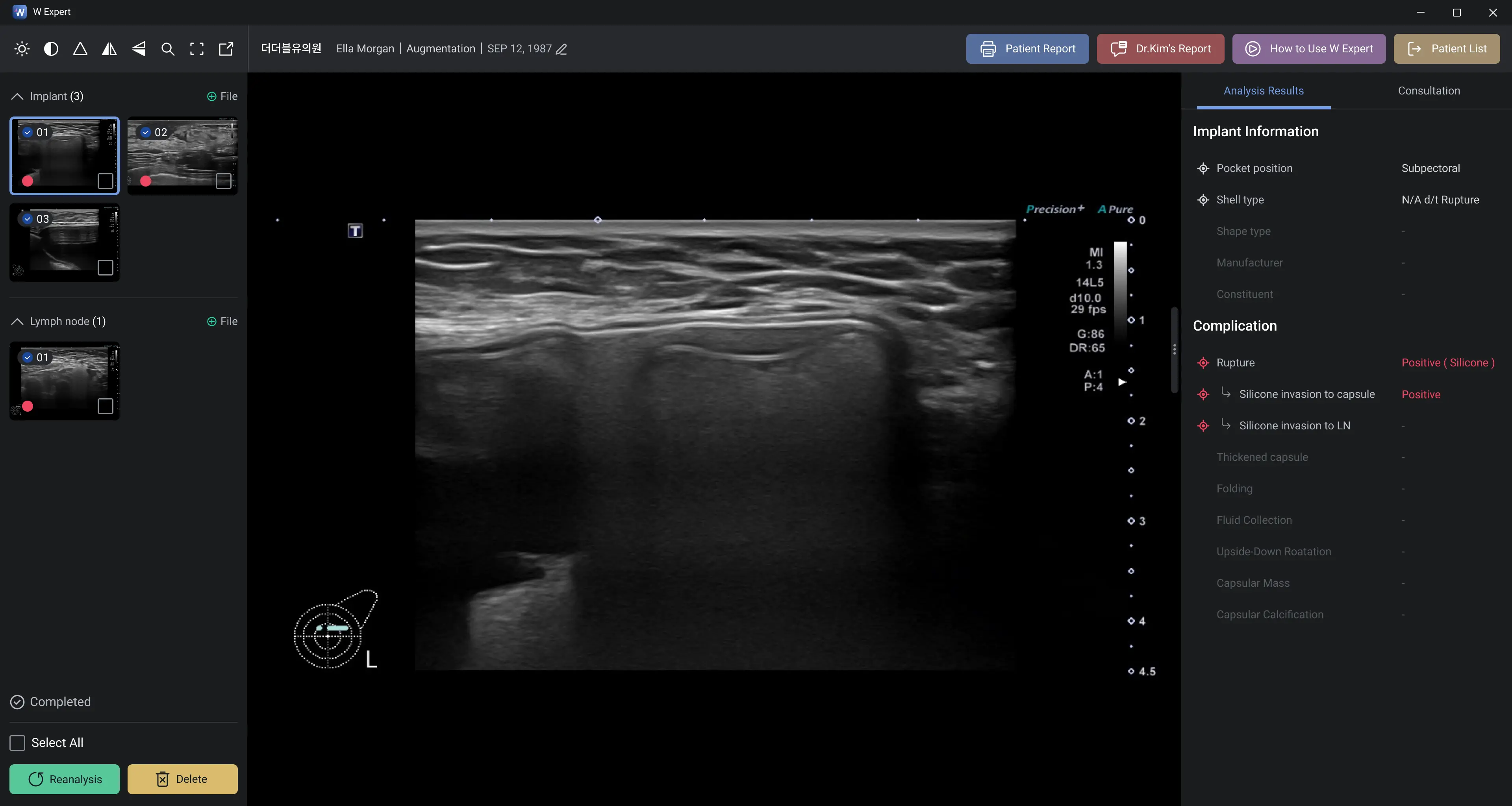 Implant Information Analysis